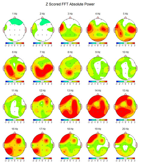 QEEG – Brain Mapping
